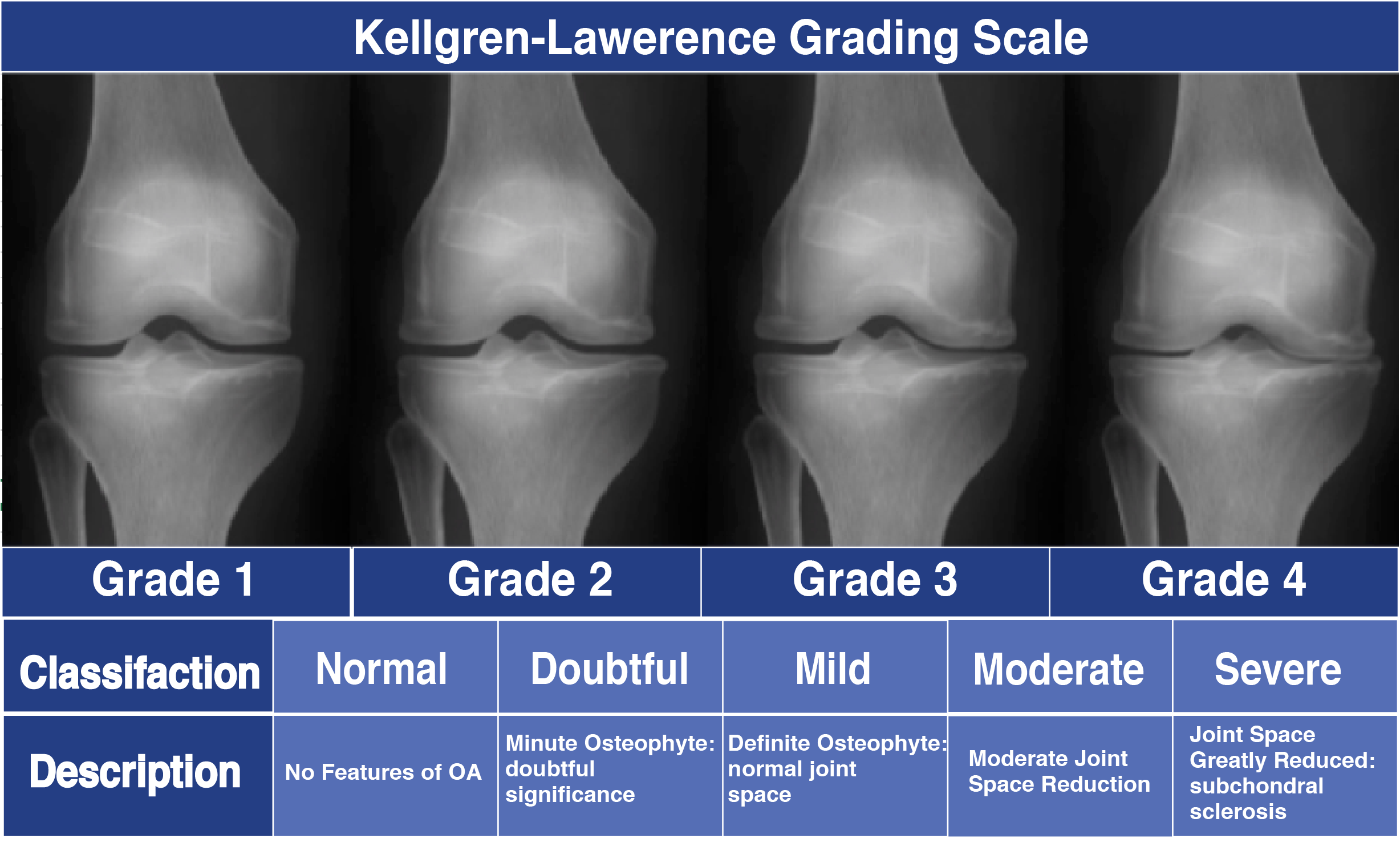 Guide To Severe Knee Arthritis Osteoarthritis Spring Loaded Technology