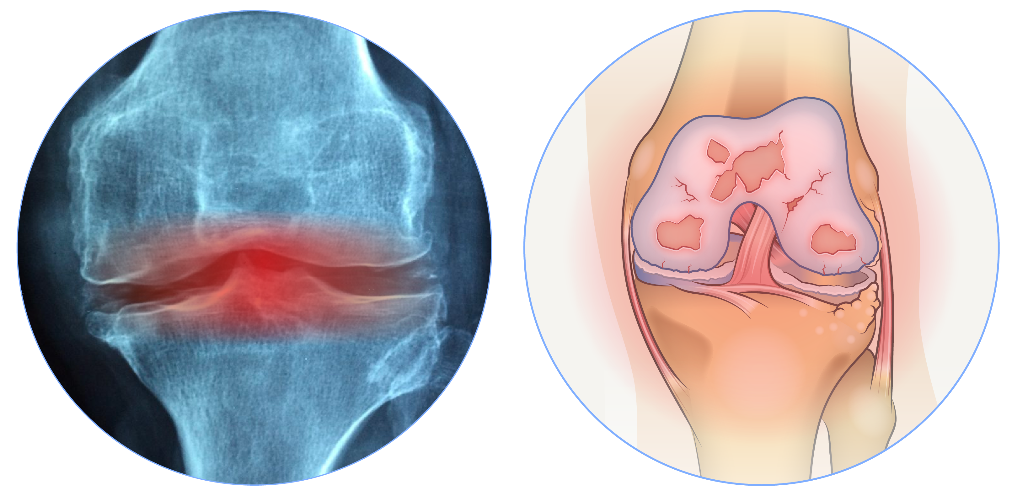osteoarthritis knee lump