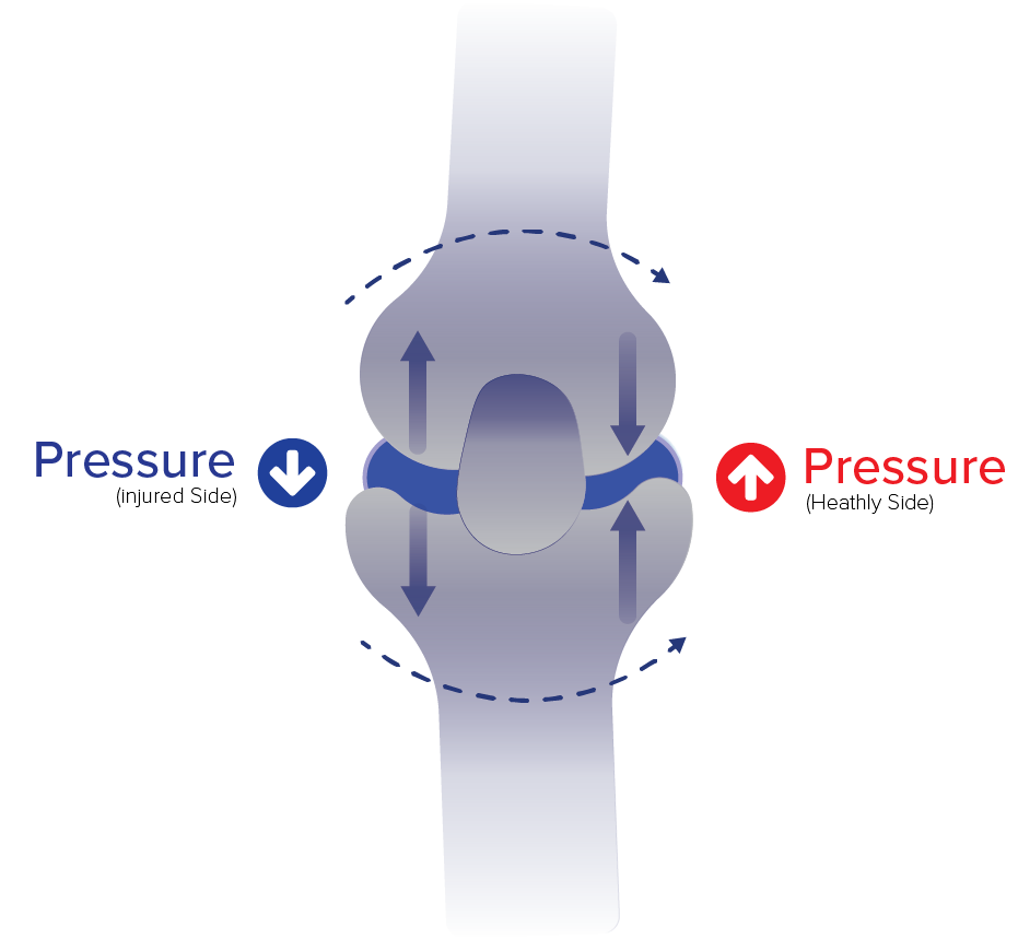 Diagram showing how uni-compartment offloader braces redistribute pressure in the knee joint.