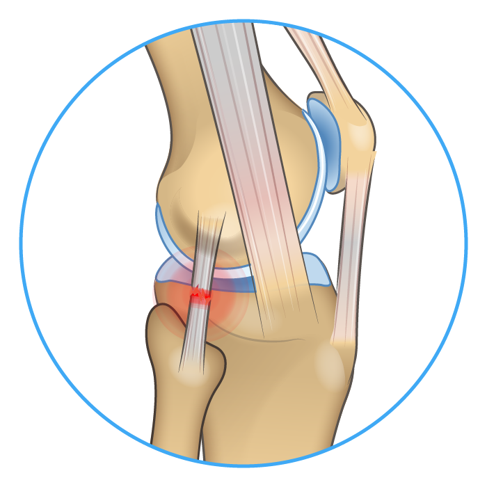 Knee Anatomy LCL Tear