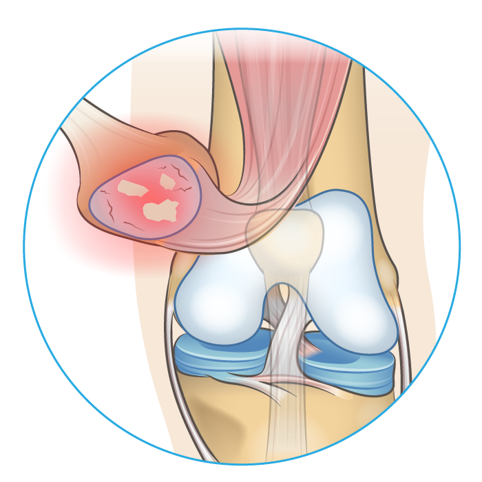 Knee anatomy diagram showing where on the joint arthritis causes pain