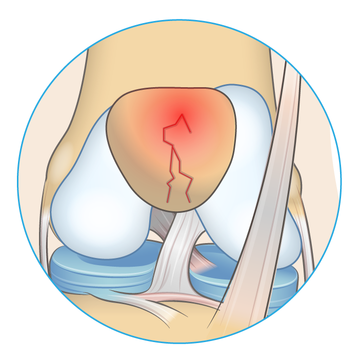 Knee anatomy diagram showing a fractured patella