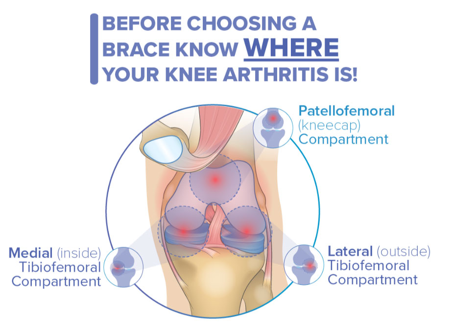Diagram showing the three compartments of the knee joint affected by osteoarthritis.