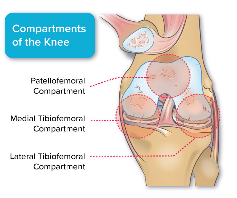 diagram of knee compartments with arthritis including patellofemoral