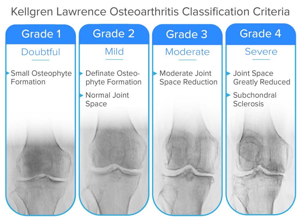 Guide To Severe Knee Arthritis Tricompartmental Osteoarthritis