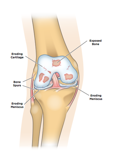 Diagram of degenerative meniscus tears and knee osteoarthritis in the same knee.