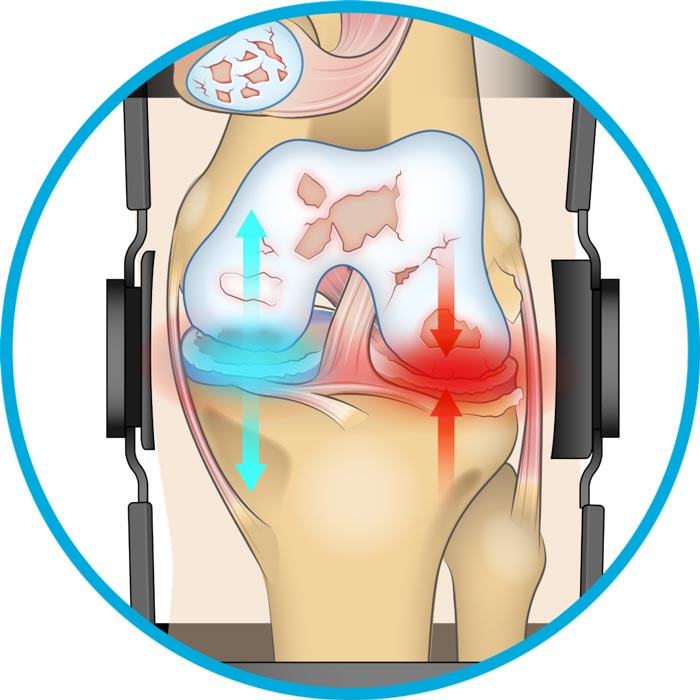 Diagram showing that a uni-compartment offloader knee brace reduces pressure on one side of the knee.