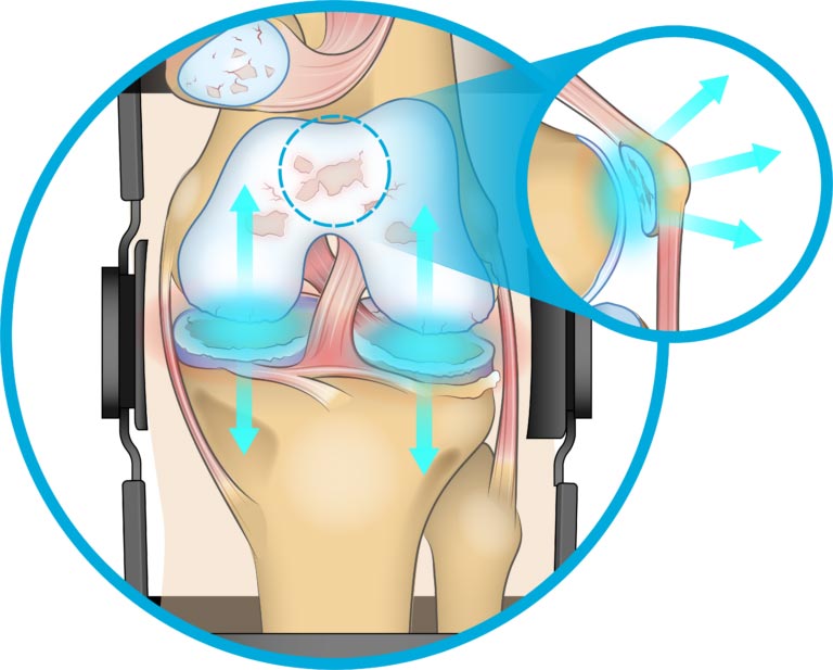 Diagram showing that a tri-compartment offloader knee brace reduces pressure across the entire knee.